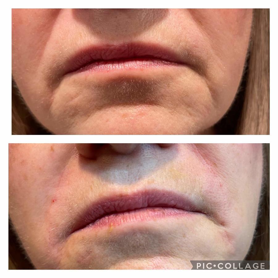 before-after-dermal-filler.jpg