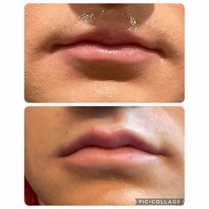 before-after-lip-filler.jpg